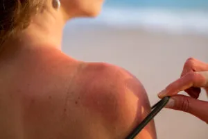 Как быстро и эффективно восстановить кожу после солнечного ожога