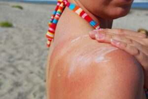 Как восстановить кожу после загара и солнечного ожога