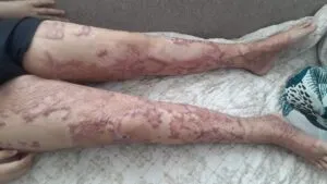 В Актау школьник стал инвалидом из-за изношенных труб